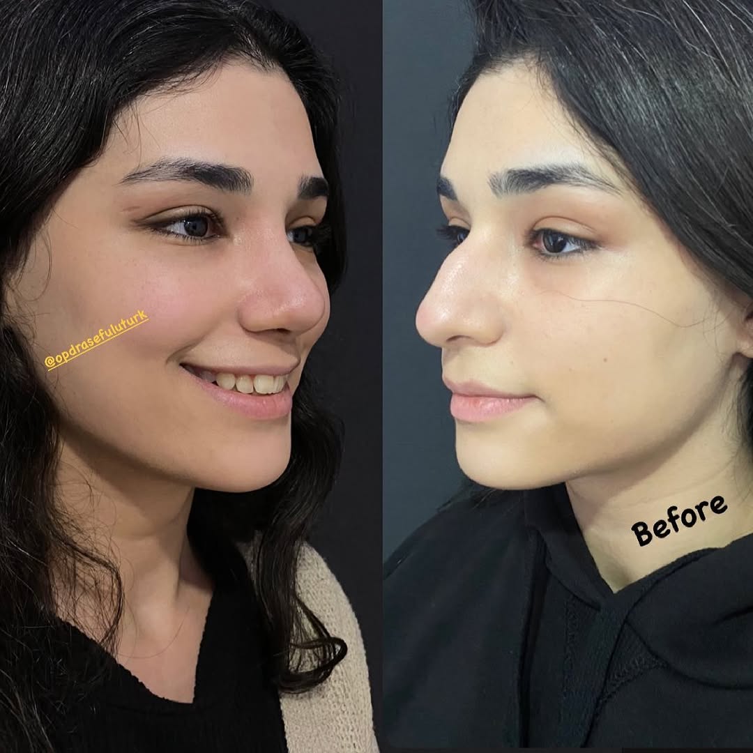 Затворена (безбелезна) ринопластика