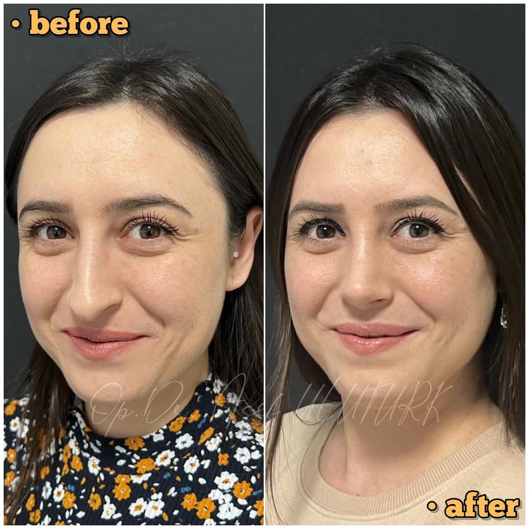 Затворена (безбелезна) ринопластика