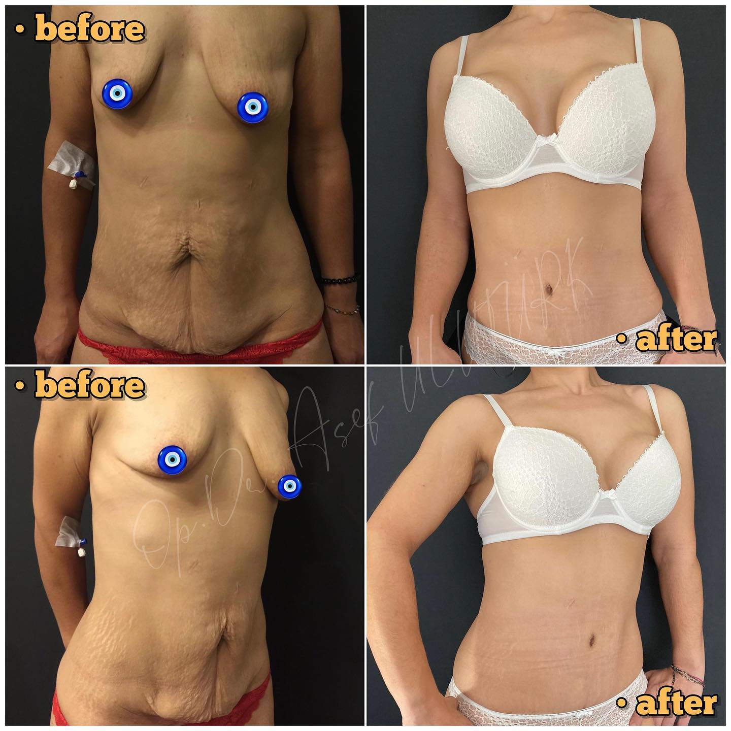 Естетика на гърдите и абдоминопластика