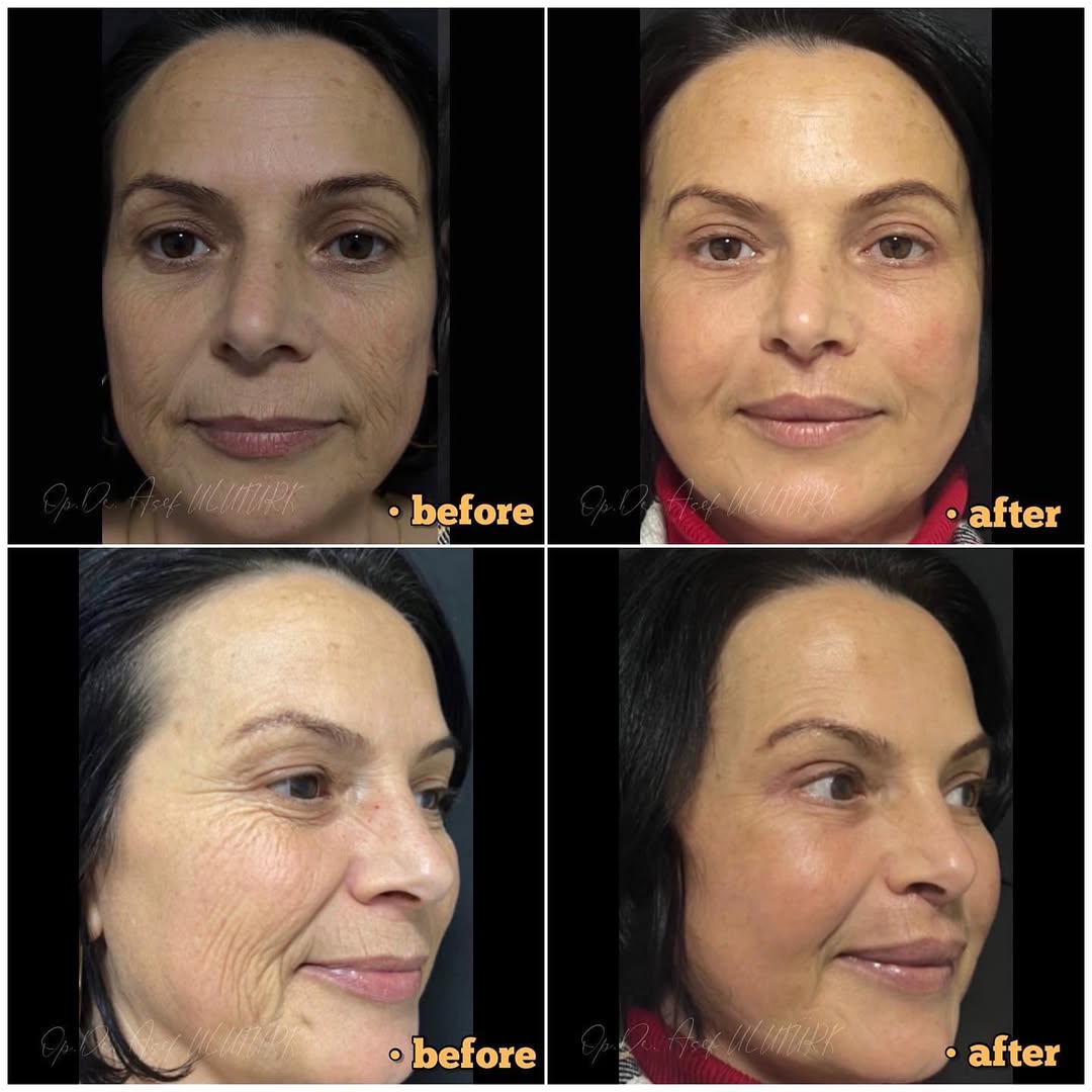 Подмладяване на лицето