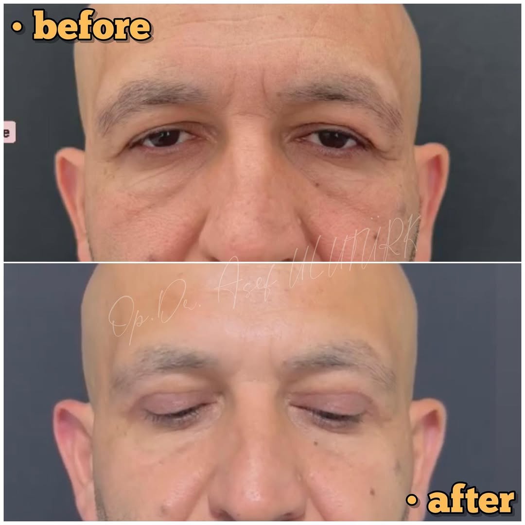 Естетика на клепачите