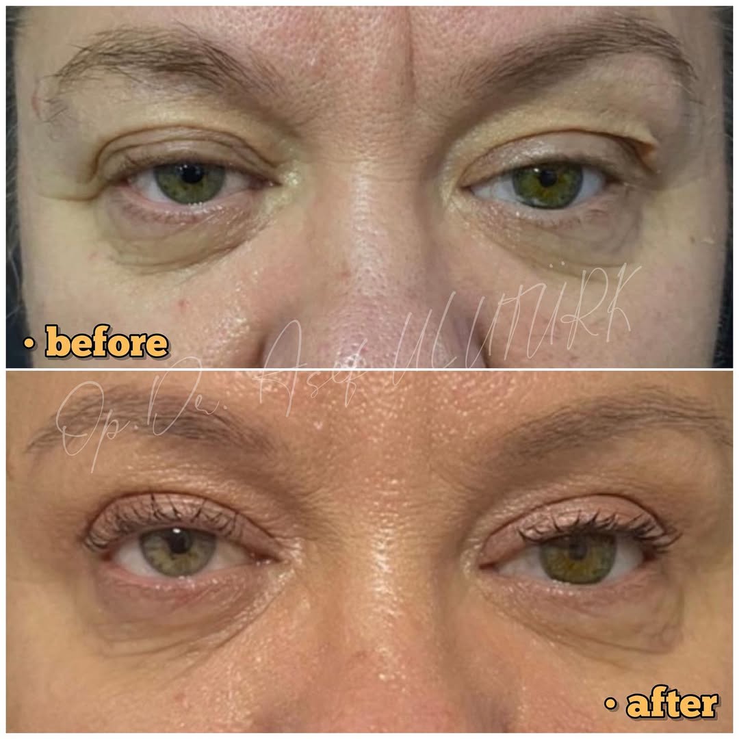 Естетика на клепачите