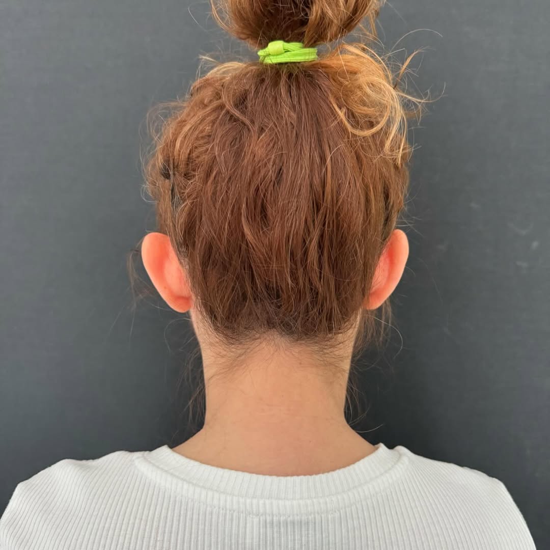 Отопластика