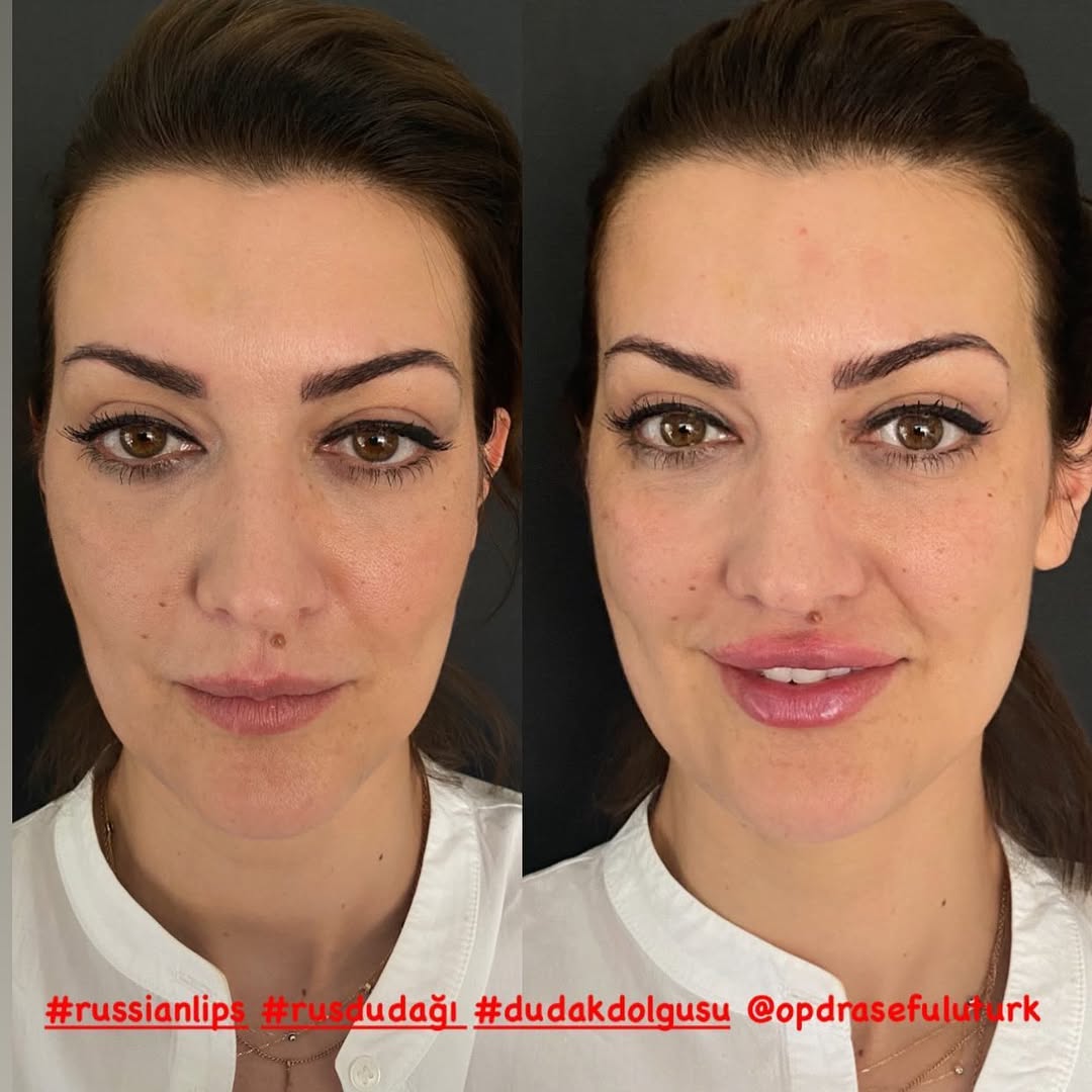 Филър за устни