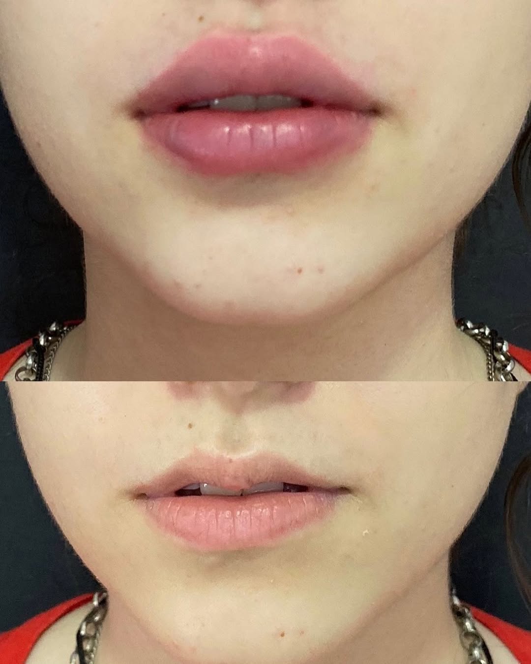 Филър за устни