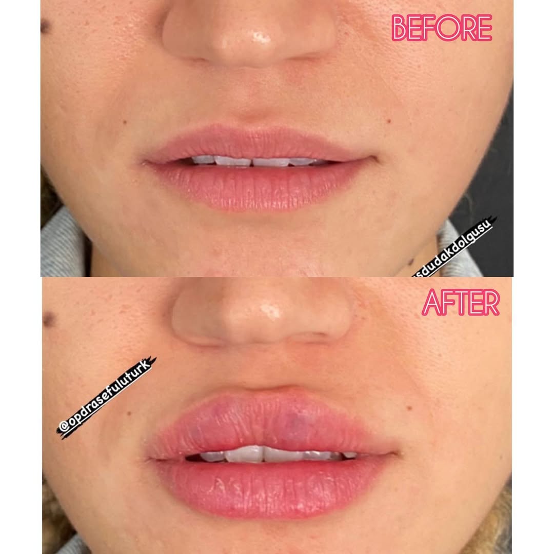 Филър за устни